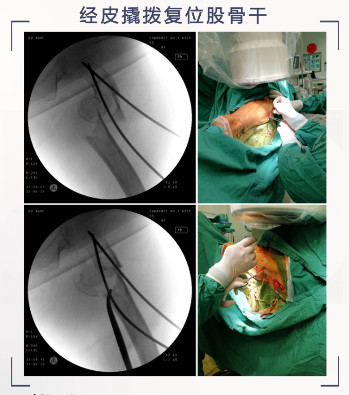 转子下骨折术后失败，原因详解与诊疗策略都在这篇！
