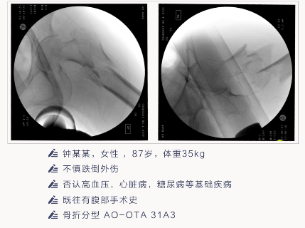 转子下骨折术后失败，原因详解与诊疗策略都在这篇！