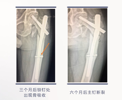 转子下骨折术后失败，原因详解与诊疗策略都在这篇！