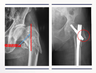转子下骨折术后失败，原因详解与诊疗策略都在这篇！
