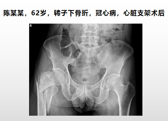 转子下骨折术后失败，原因详解与诊疗策略都在这篇！