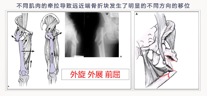 转子下骨折术后失败，原因详解与诊疗策略都在这篇！