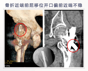 转子下骨折术后失败，原因详解与诊疗策略都在这篇！