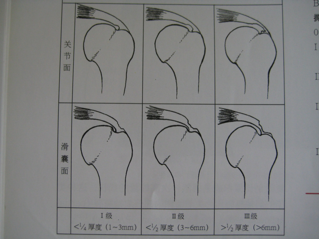 最全肩袖损伤诊断与治疗关键汇总，内附超详细检查手段！