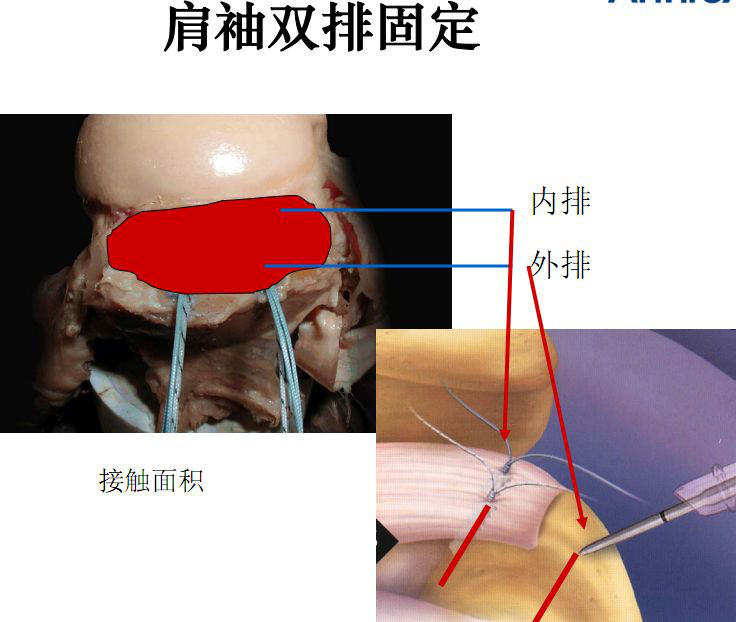 最全肩袖损伤诊断与治疗关键汇总，内附超详细检查手段！