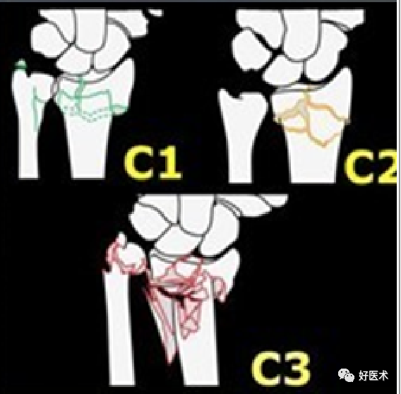 掌握这5个热点问题，你也可以做好桡骨远端骨折！