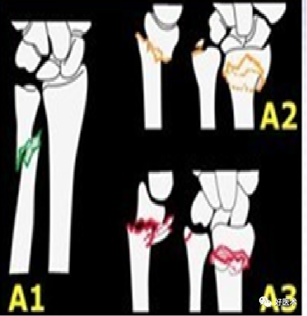 掌握这5个热点问题，你也可以做好桡骨远端骨折！