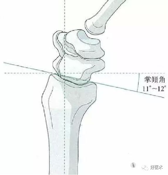 掌握这5个热点问题，你也可以做好桡骨远端骨折！