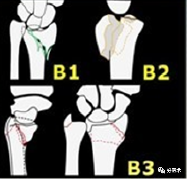 掌握这5个热点问题，你也可以做好桡骨远端骨折！