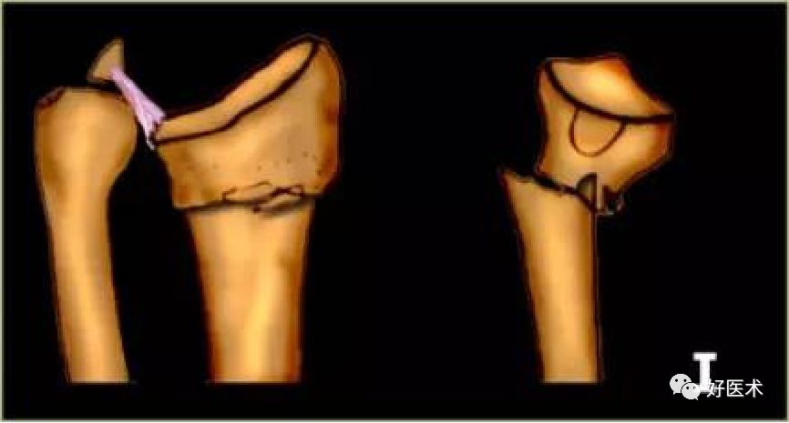 掌握这5个热点问题，你也可以做好桡骨远端骨折！