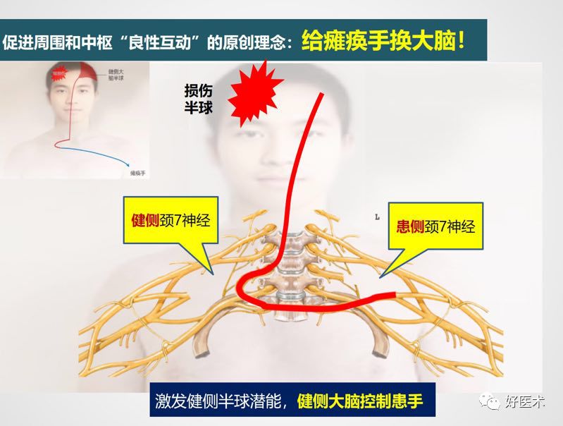 给瘫痪手换大脑，治疗中枢性上肢偏瘫不再是梦