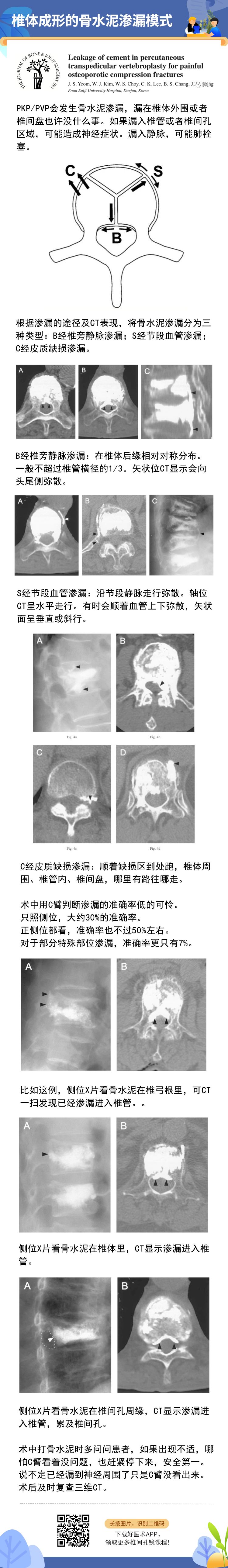 椎体成形术常见问题汇总，赶紧收藏备用！