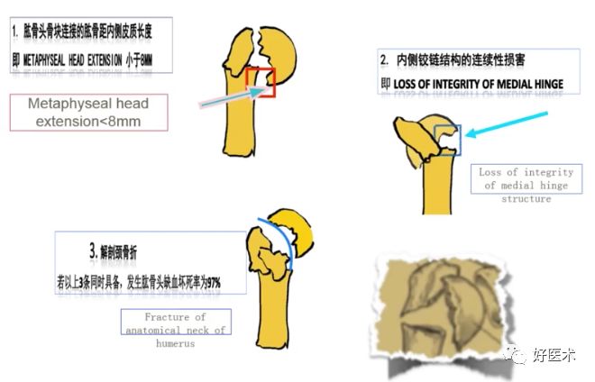 肩关节损伤的治疗选择，看这篇就够了！