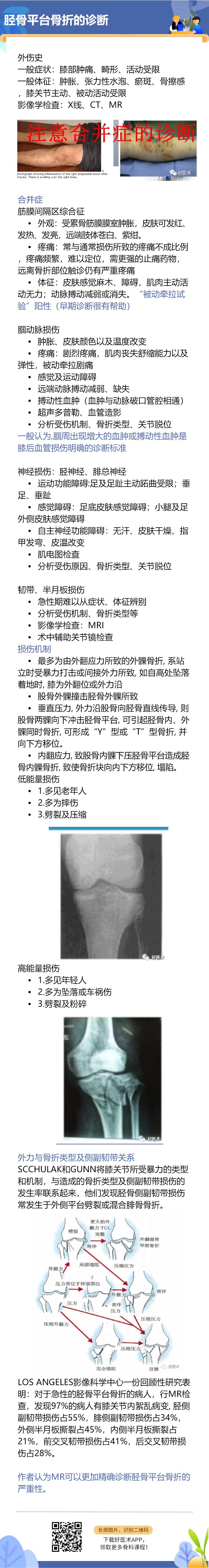 一目了然！5张图教你做好胫骨平台骨折！