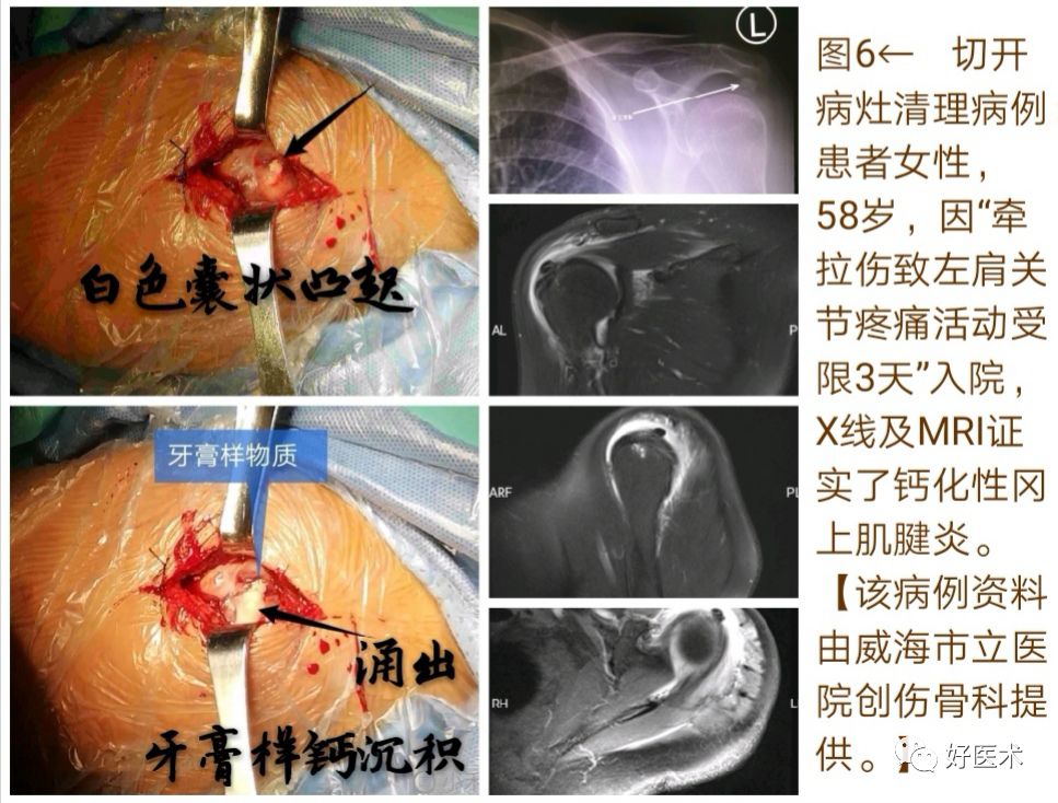 肩袖钙化性肌腱炎十大要点详解，帮你彻底整明白！