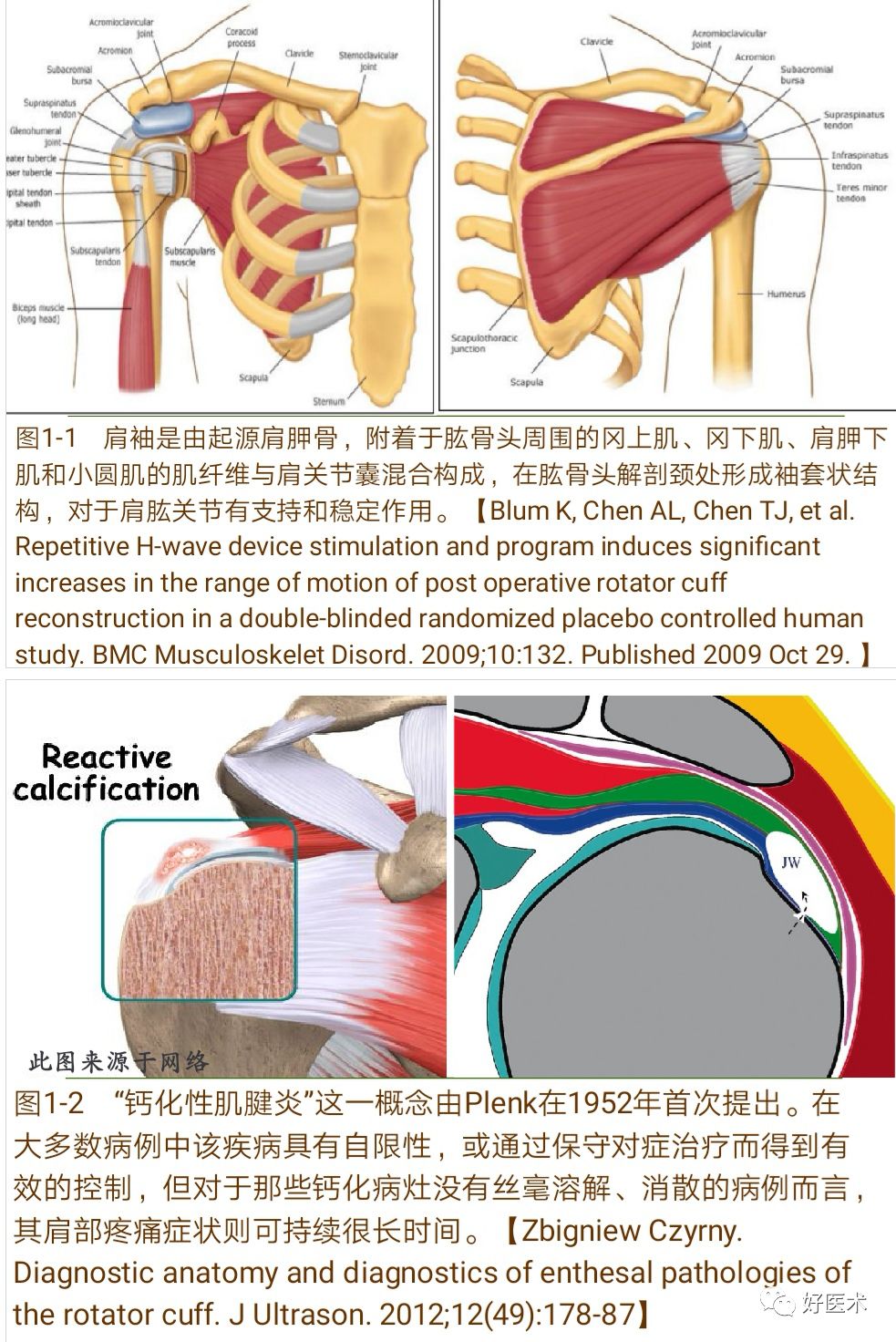 肩袖钙化性肌腱炎十大要点详解，帮你彻底整明白！