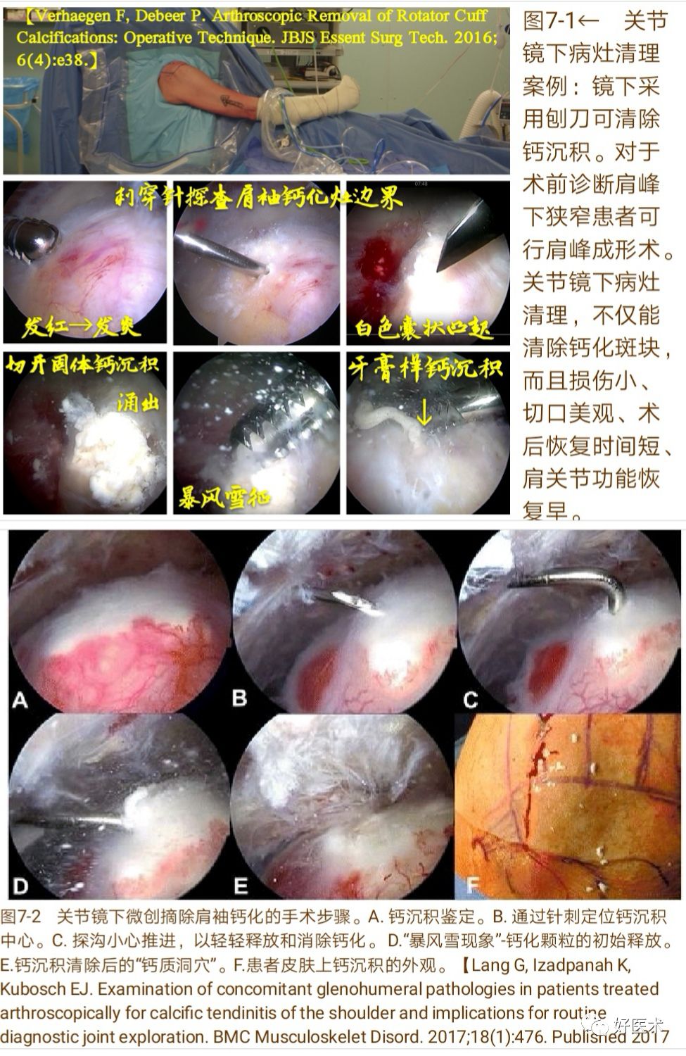 肩袖钙化性肌腱炎十大要点详解，帮你彻底整明白！