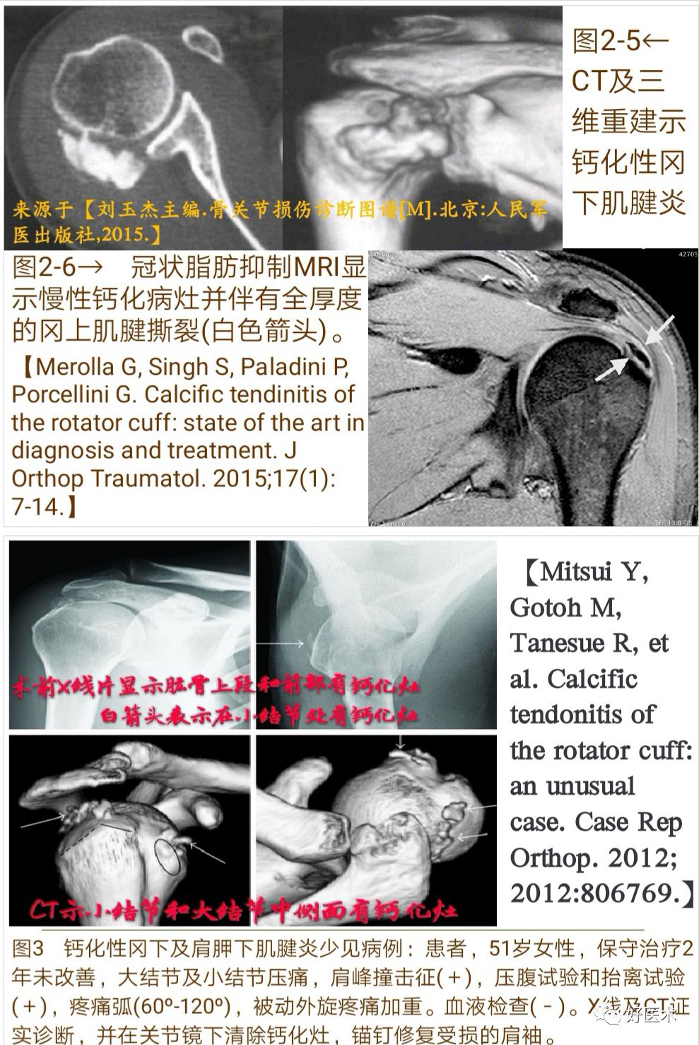 肩袖钙化性肌腱炎十大要点详解，帮你彻底整明白！