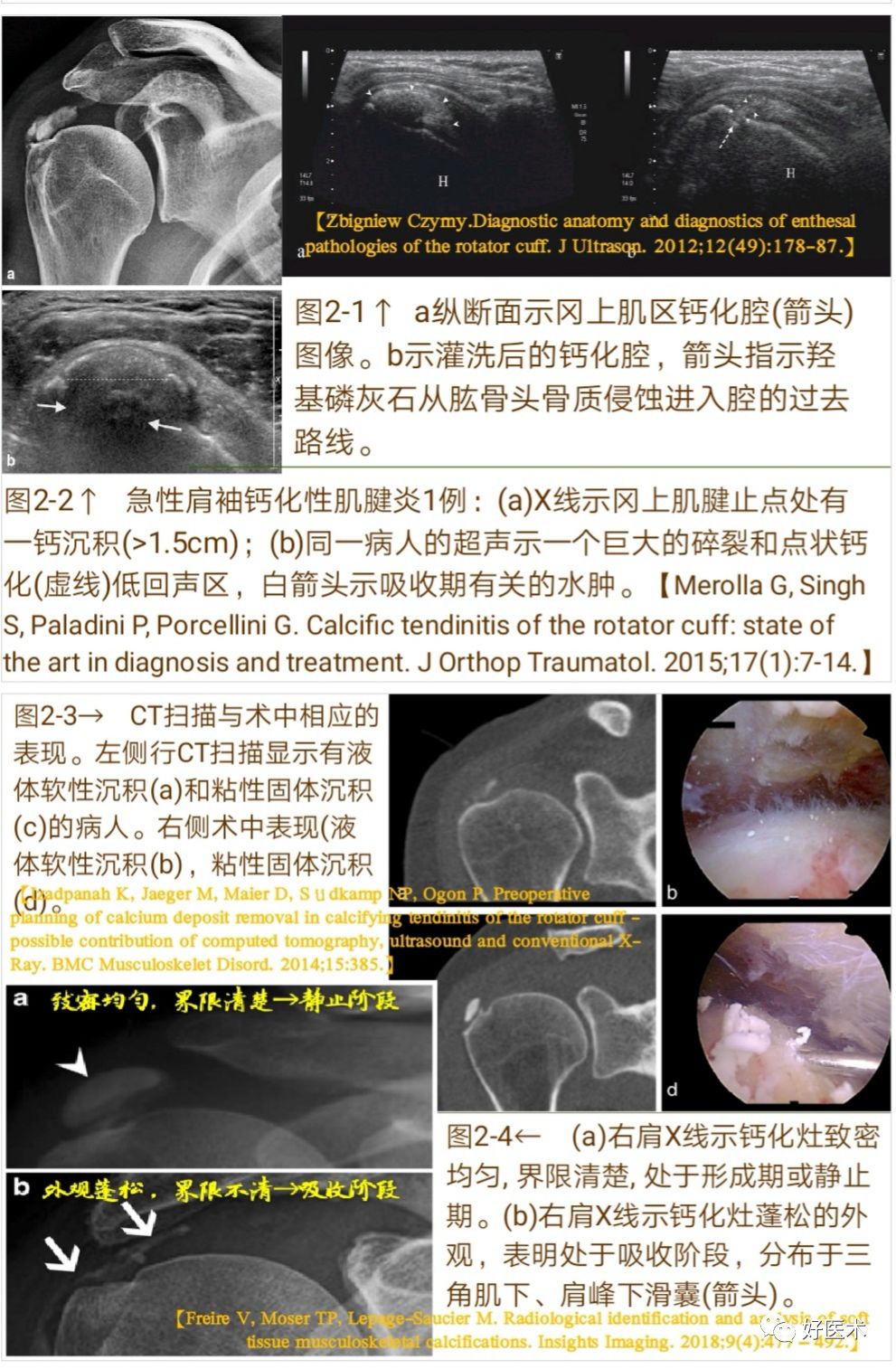 肩袖钙化性肌腱炎十大要点详解，帮你彻底整明白！