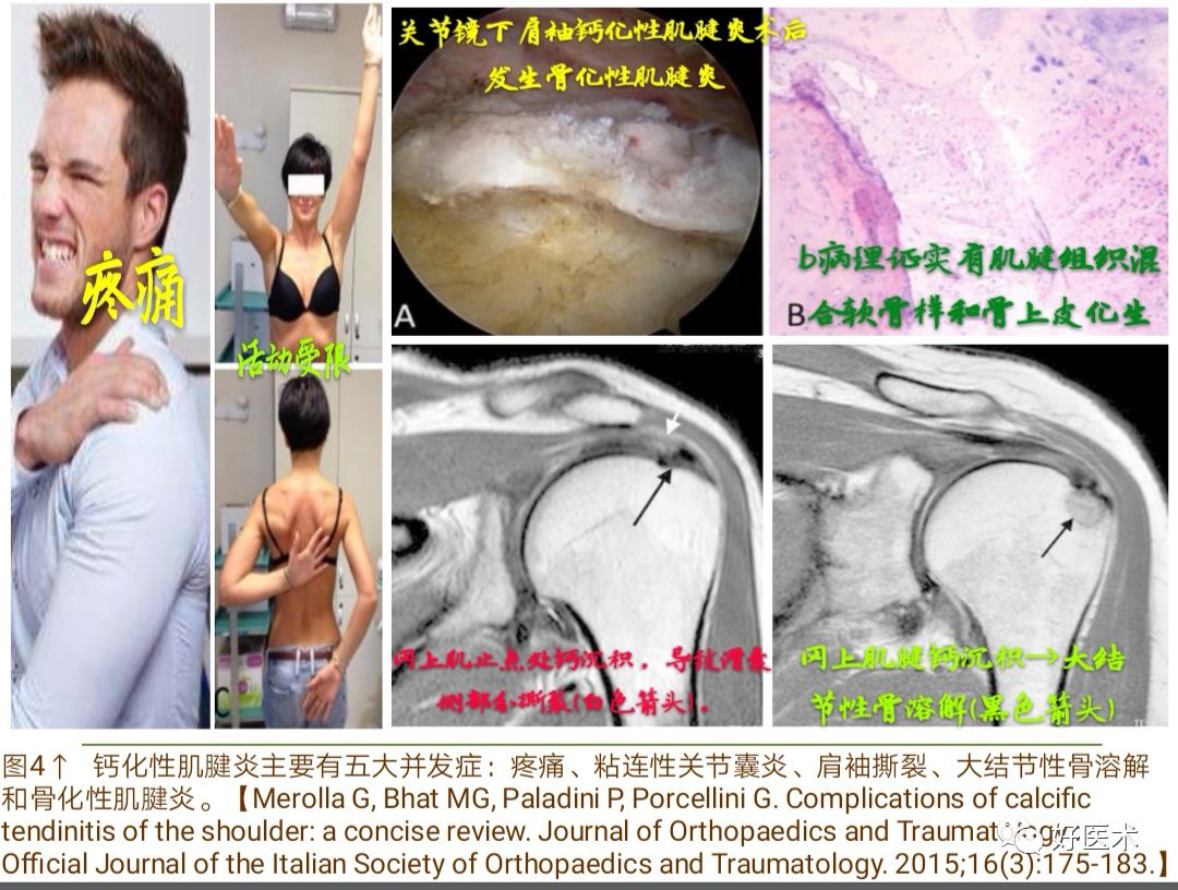 肩袖钙化性肌腱炎十大要点详解，帮你彻底整明白！