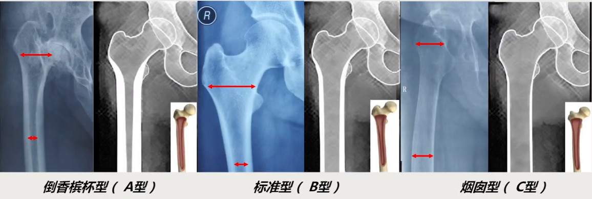 如何做好一台完美的初次髋关节置换，技巧全在这!