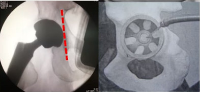 如何做好一台完美的初次髋关节置换，技巧全在这!