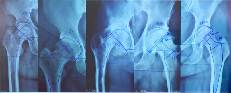 如何做好一台完美的初次髋关节置换，技巧全在这!