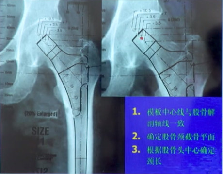 如何做好一台完美的初次髋关节置换，技巧全在这!