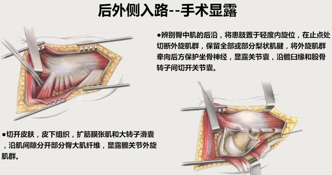 如何做好一台完美的初次髋关节置换，技巧全在这!