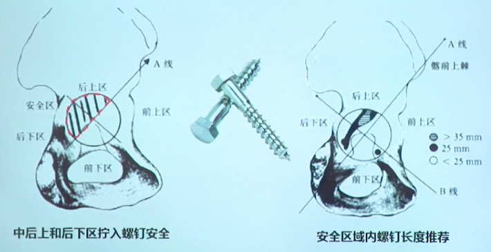 如何做好一台完美的初次髋关节置换，技巧全在这!