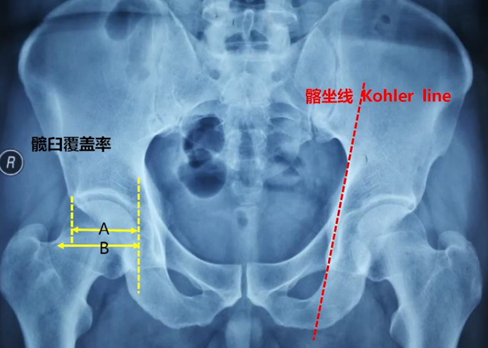 如何做好一台完美的初次髋关节置换，技巧全在这!