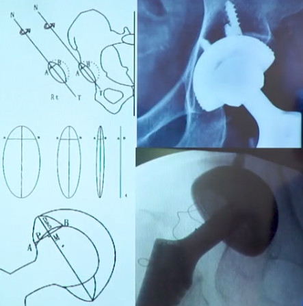如何做好一台完美的初次髋关节置换，技巧全在这!