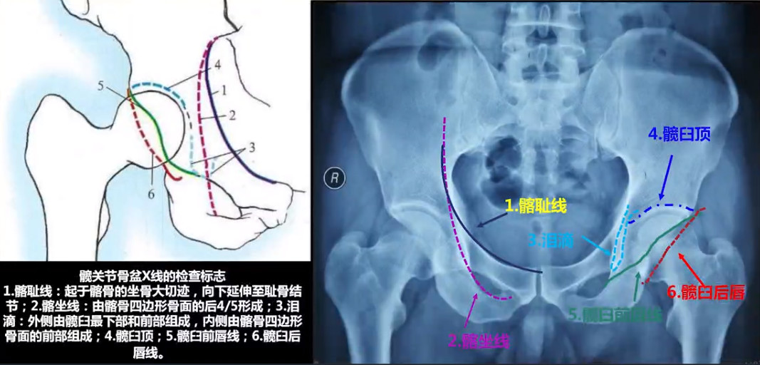 如何做好一台完美的初次髋关节置换，技巧全在这!