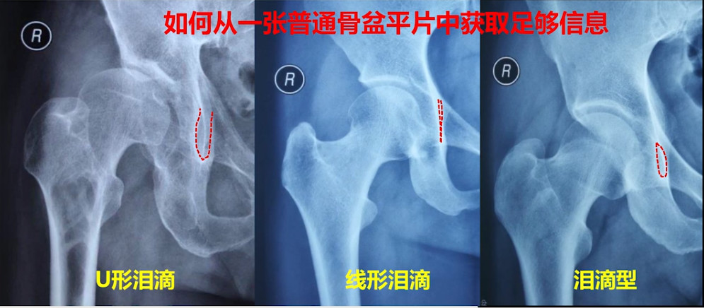 如何做好一台完美的初次髋关节置换，技巧全在这!