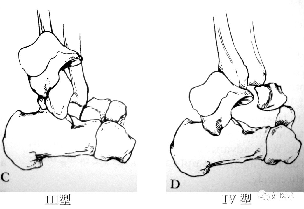 距骨骨折的治疗方法全解析，值得一看！