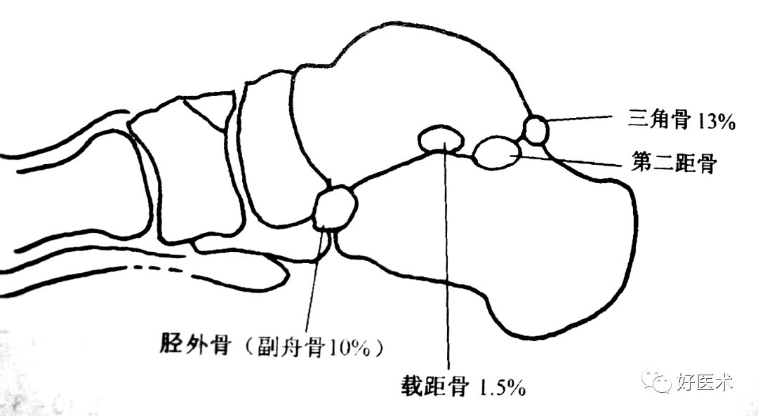 距骨骨折的治疗方法全解析，值得一看！