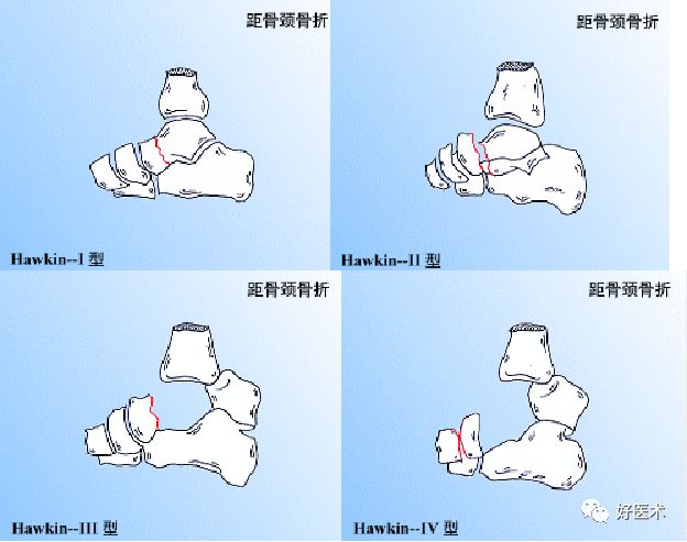 距骨骨折的治疗方法全解析，值得一看！