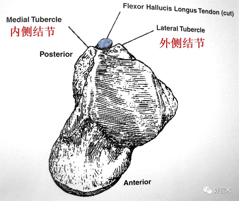 距骨骨折的治疗方法全解析，值得一看！