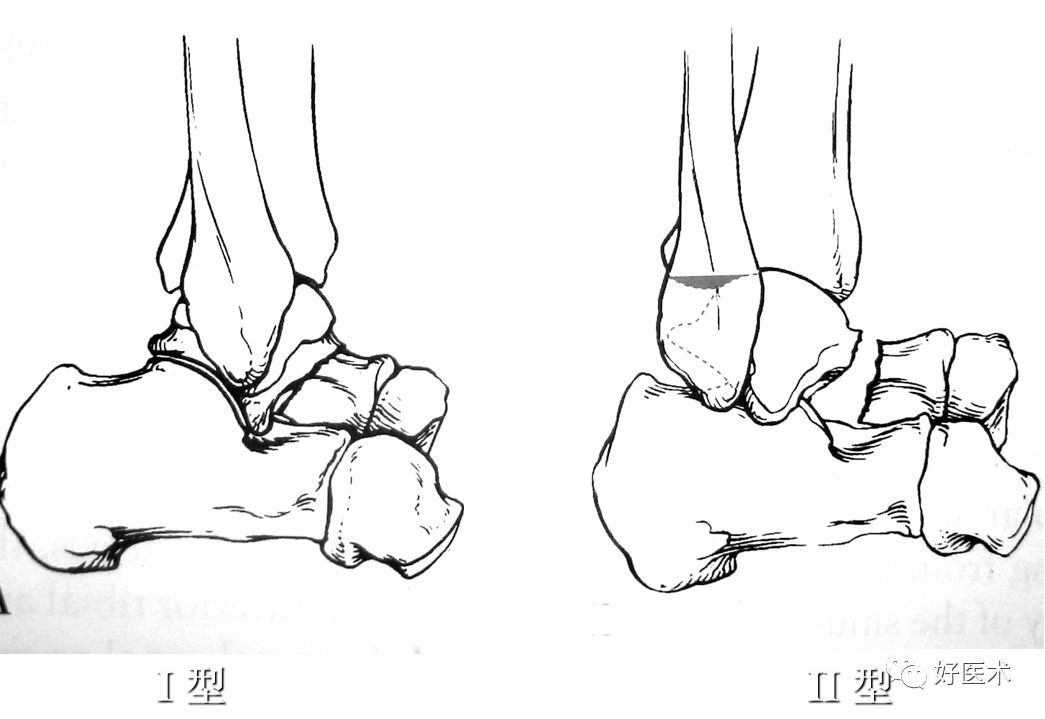 距骨骨折的治疗方法全解析，值得一看！