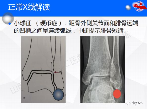 一文详解！踝关节的应用解剖及正常X线解读