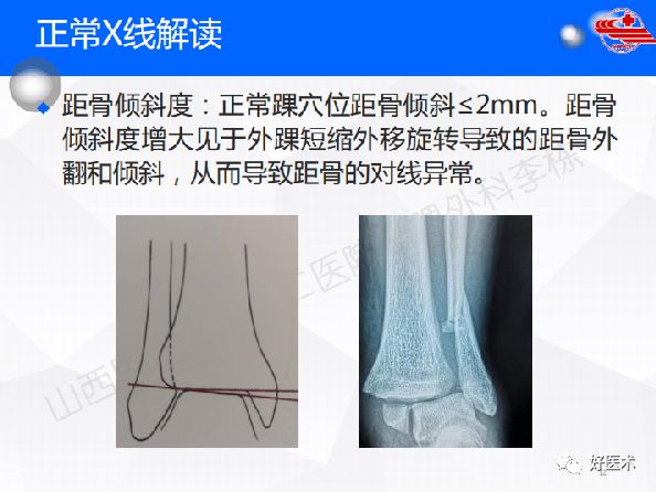 一文详解！踝关节的应用解剖及正常X线解读