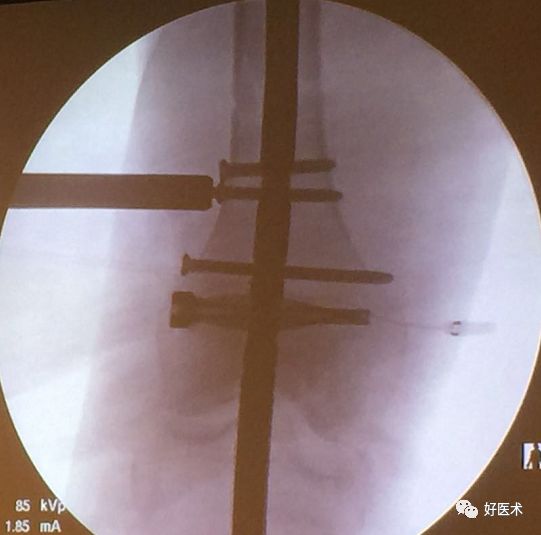 经验交流帖：高难度髓内钉病例大集合！