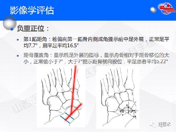 成人获得性平足的诊治，全面讲解！