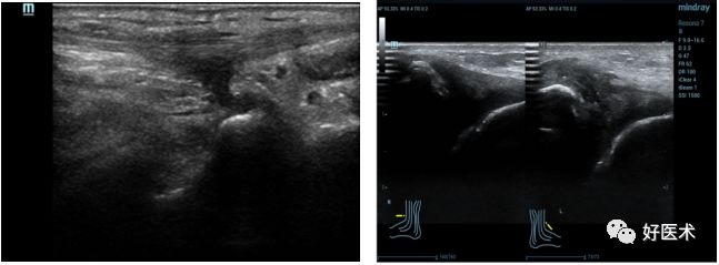 踝关节外侧副韧带损伤的影像学诊断，详细解析！