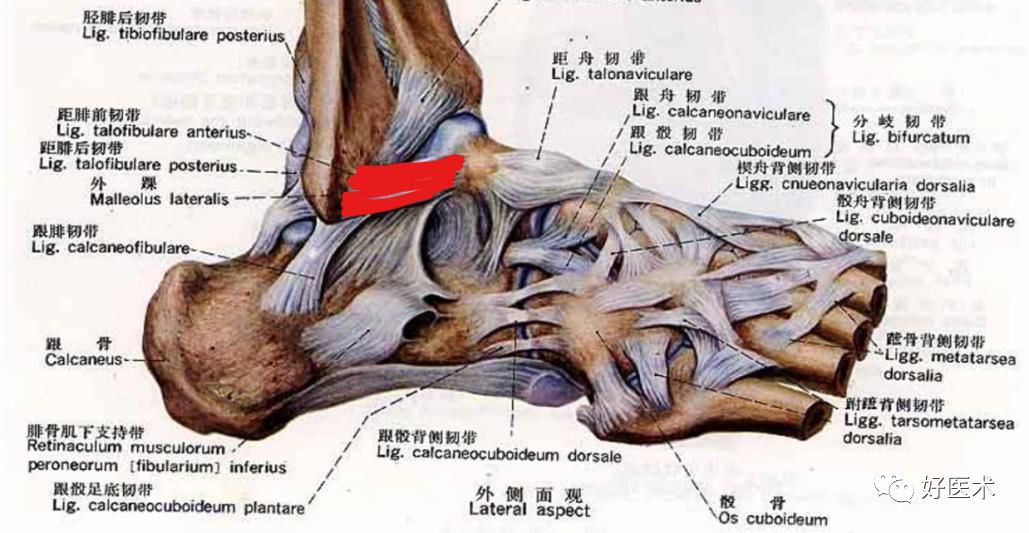 踝关节外侧副韧带损伤的影像学诊断，详细解析！