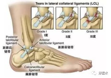 踝关节外侧副韧带损伤的影像学诊断，详细解析！