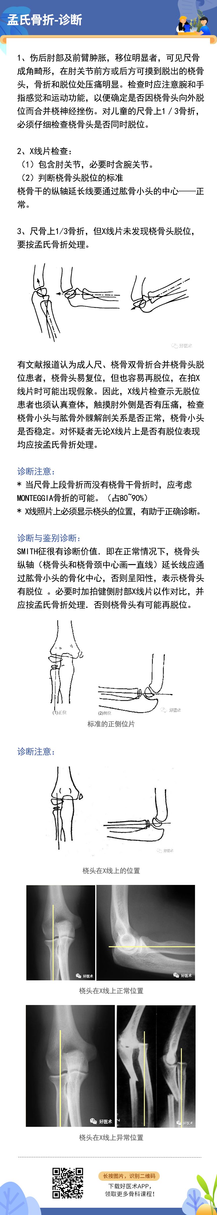 关于孟氏骨折，这篇文章讲得太全面了！