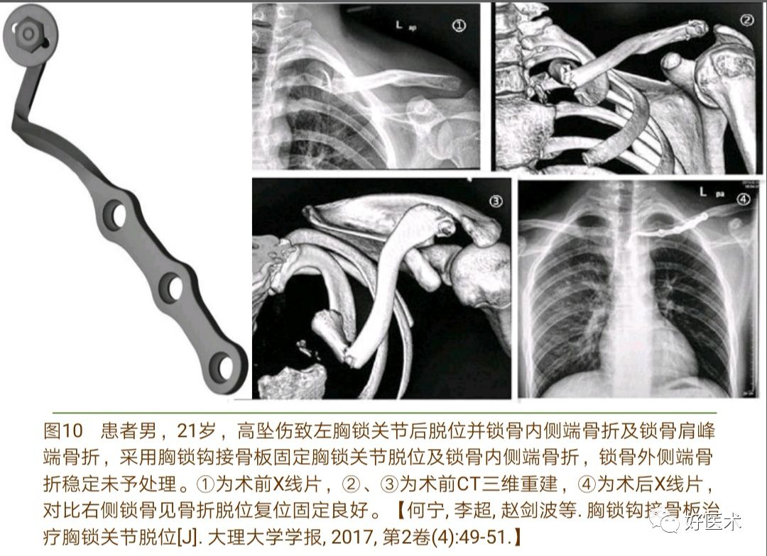 胸锁关节脱位的诊治技巧，系统详解！