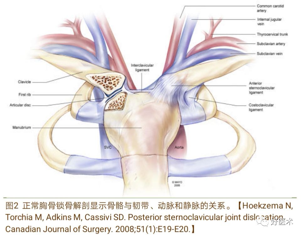 胸锁关节脱位的诊治技巧，系统详解！