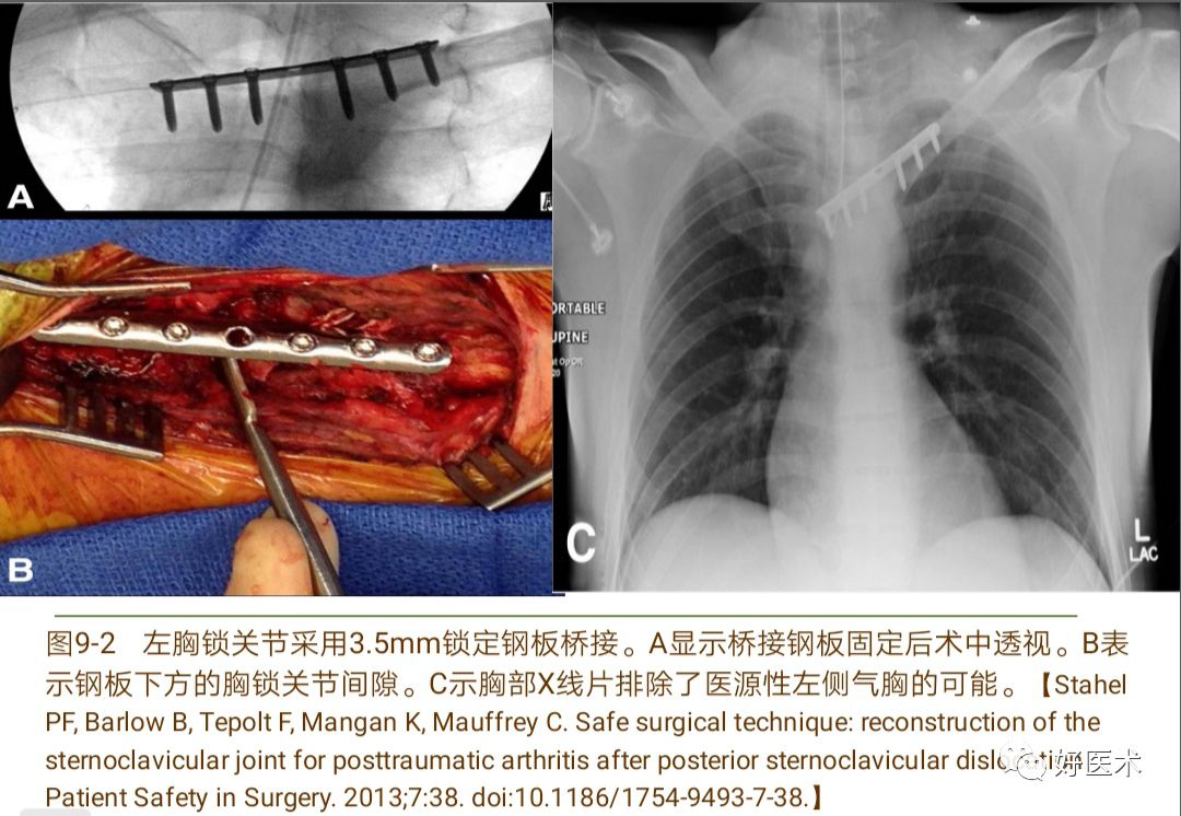 胸锁关节脱位的诊治技巧，系统详解！